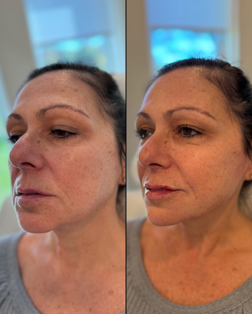 Before and After Image: Facial Balancing with Dermal Fillers - left-front-oblique