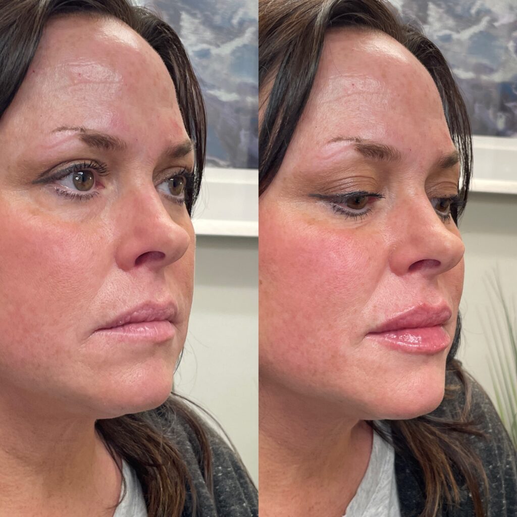 Before and After Image: Lip Filler - right-front-oblique