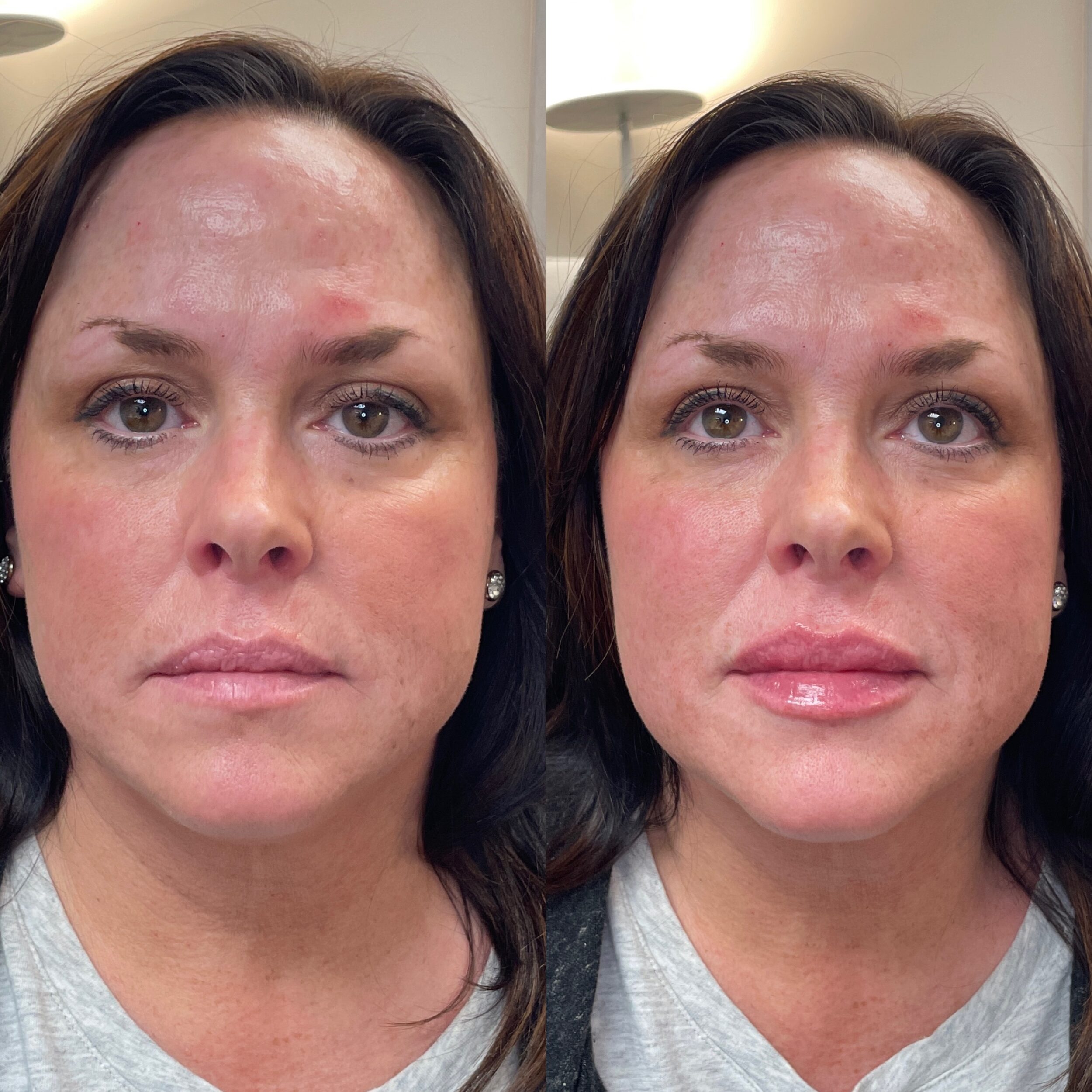 Before and After Image: Lip Filler - front