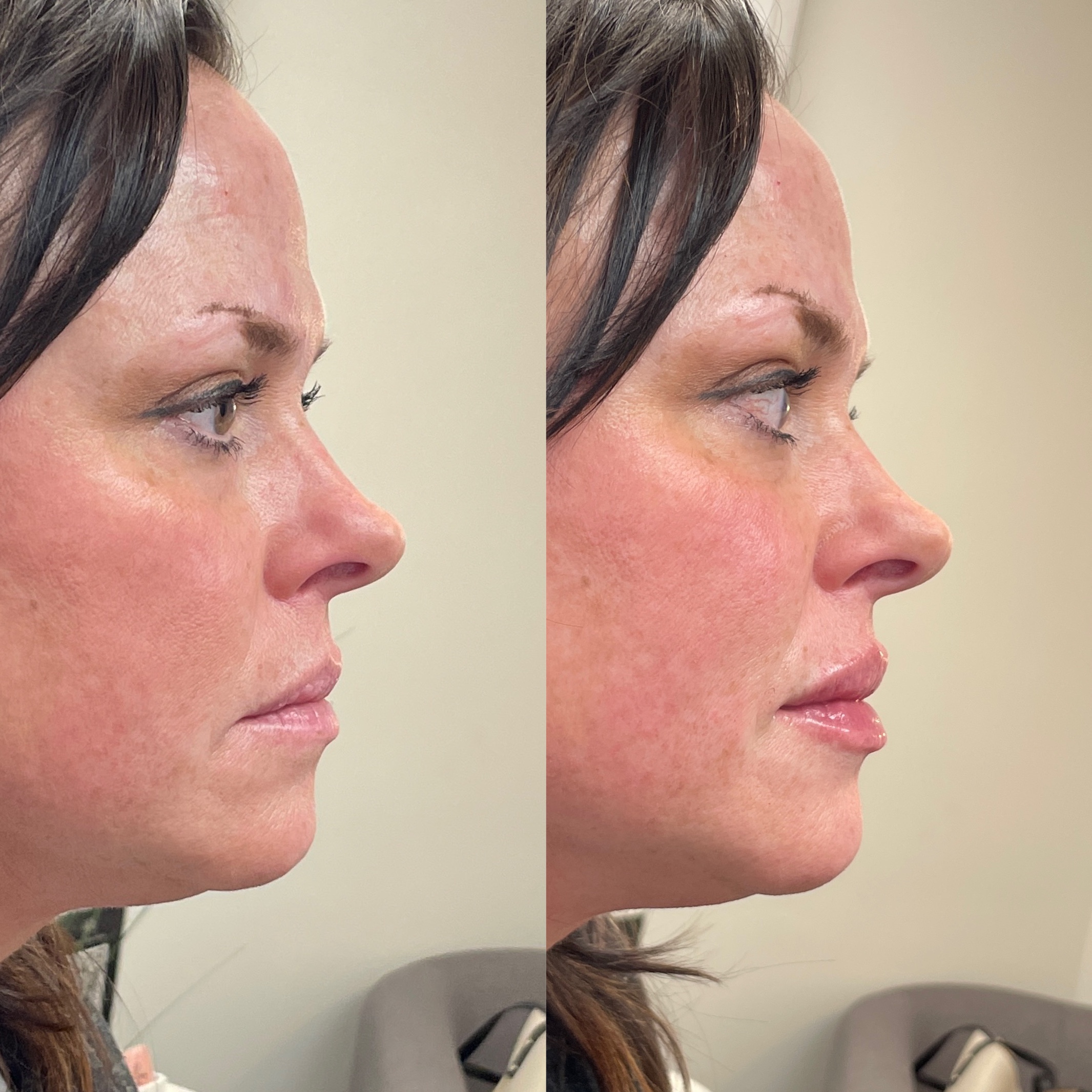 Before and After Image: Lip Filler - right-side