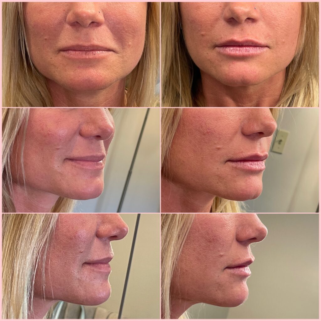 Before and After Image: Lip Filler - other