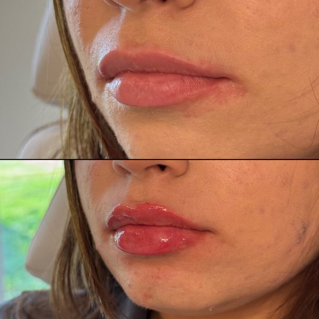 Before and After Image: Lips - left-front-oblique