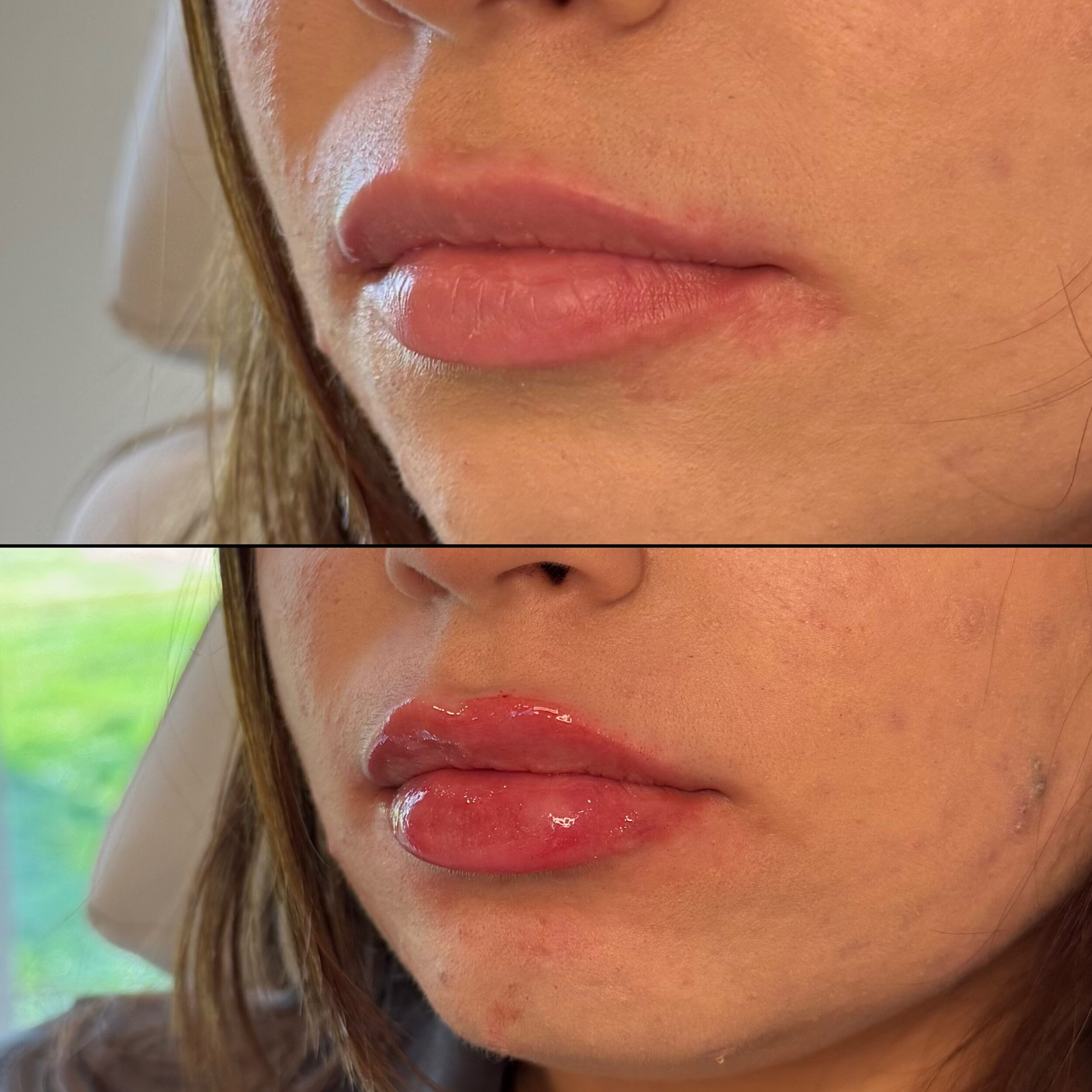 Before and After Image: Lips - left-front-oblique