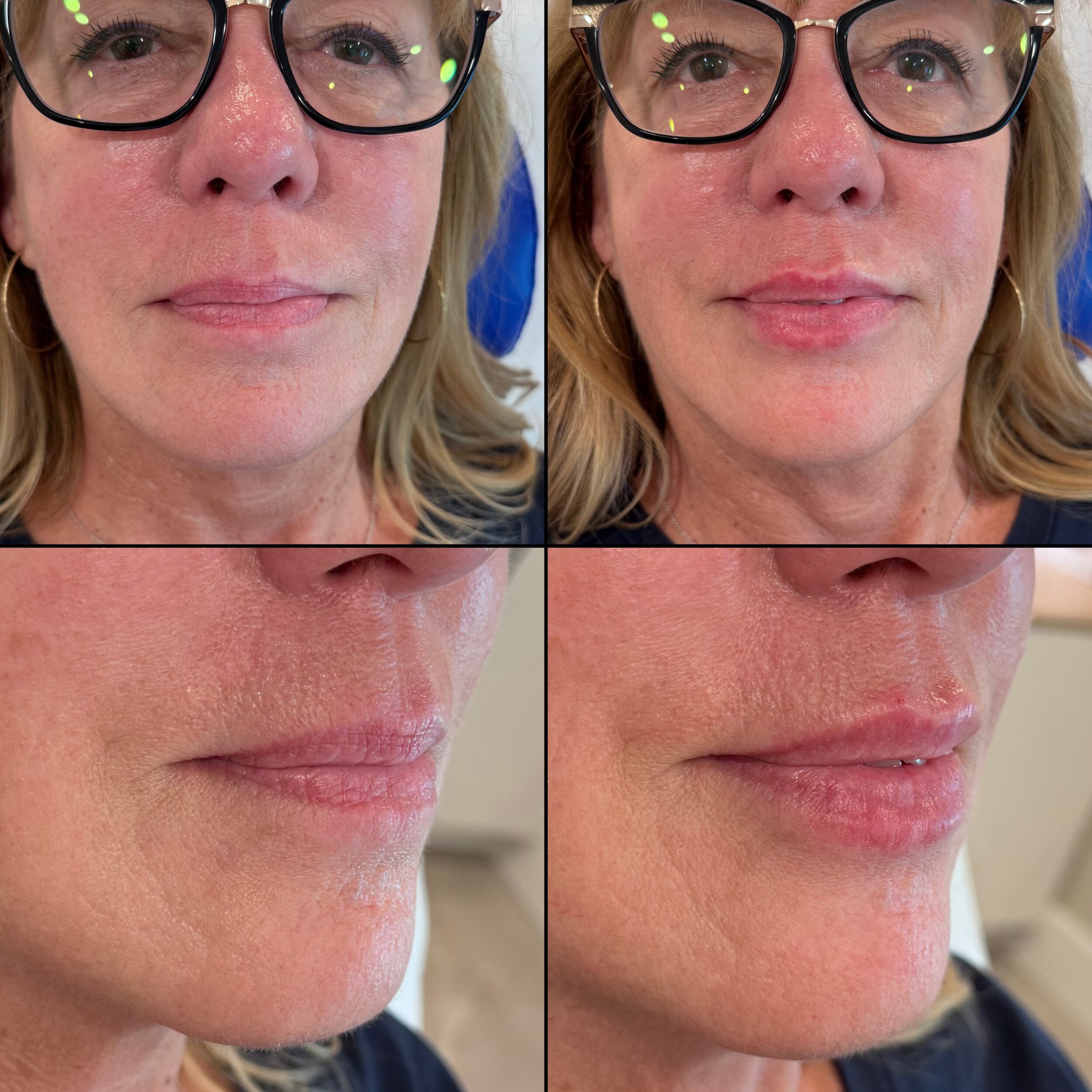 Before and After Image: Lips - front