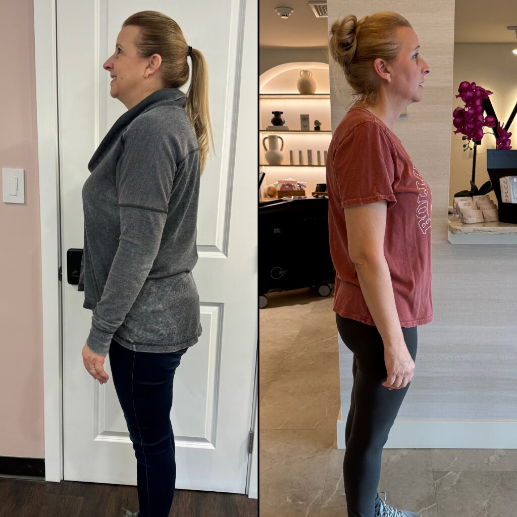 Before and After Image: Weight Loss - other