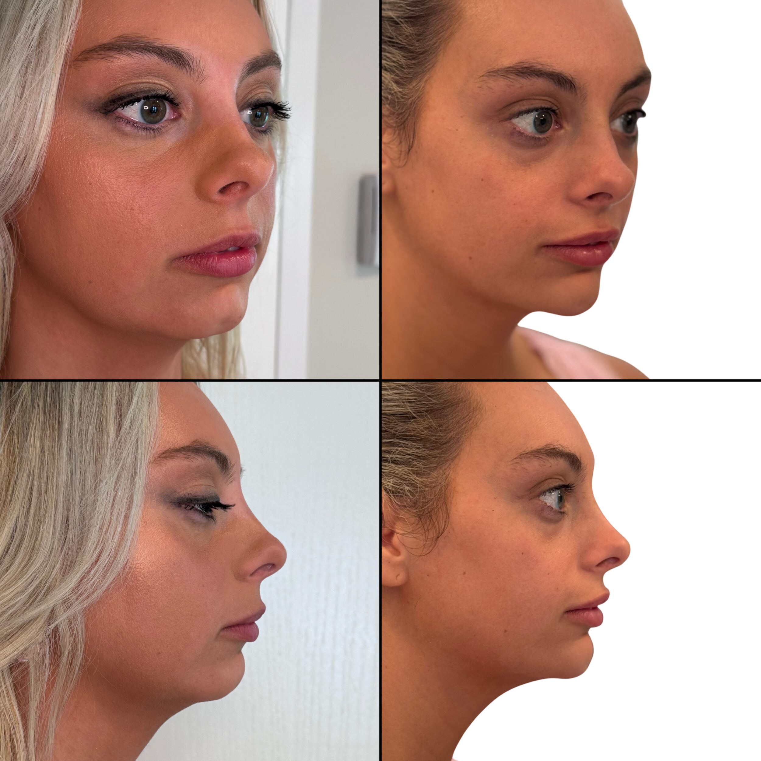 Before and After Image: Chin Filler, Lower Face Tox - other