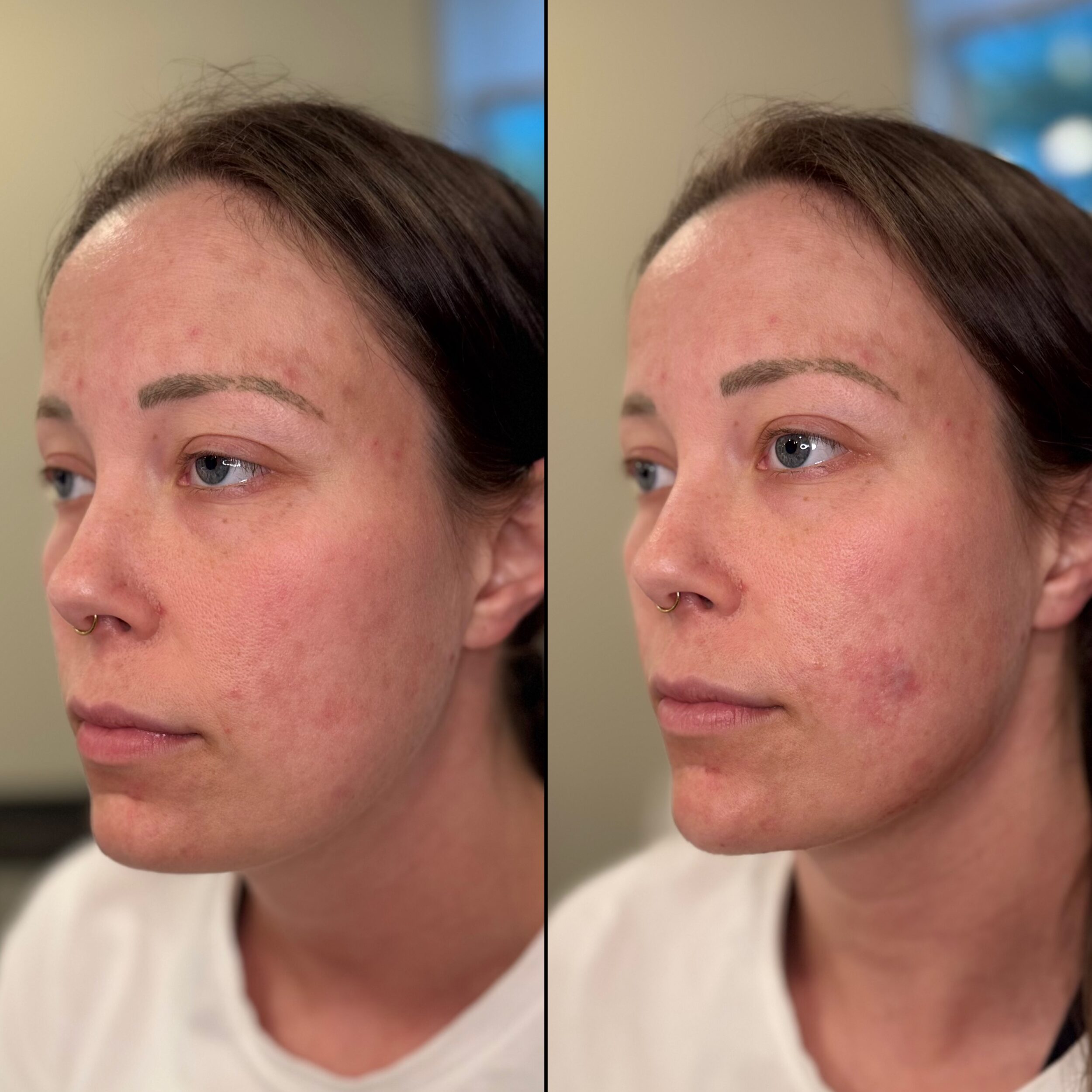 Before and After Image: Chin and Jawline Filler - left-front-oblique