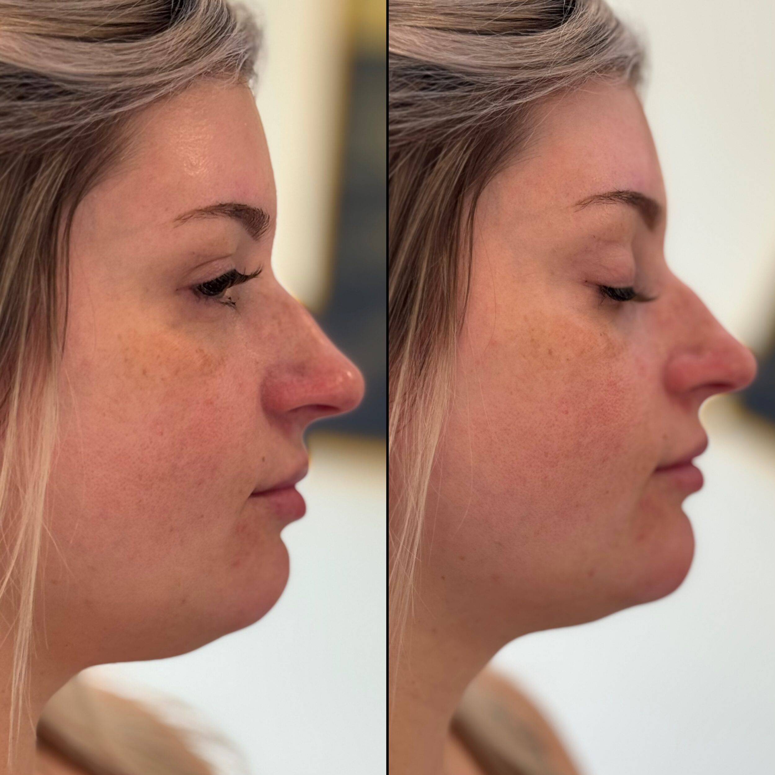 Before and After Image: Lower Face Tox, Lip Enhancement, Chin Enhancement - right-side