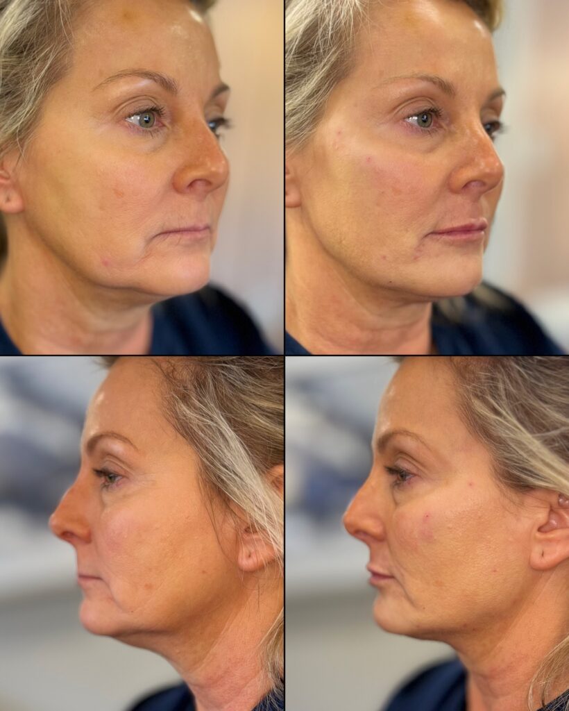 Before and After Image: Facial Balancing with Combination Dermal Filler and Tox - other