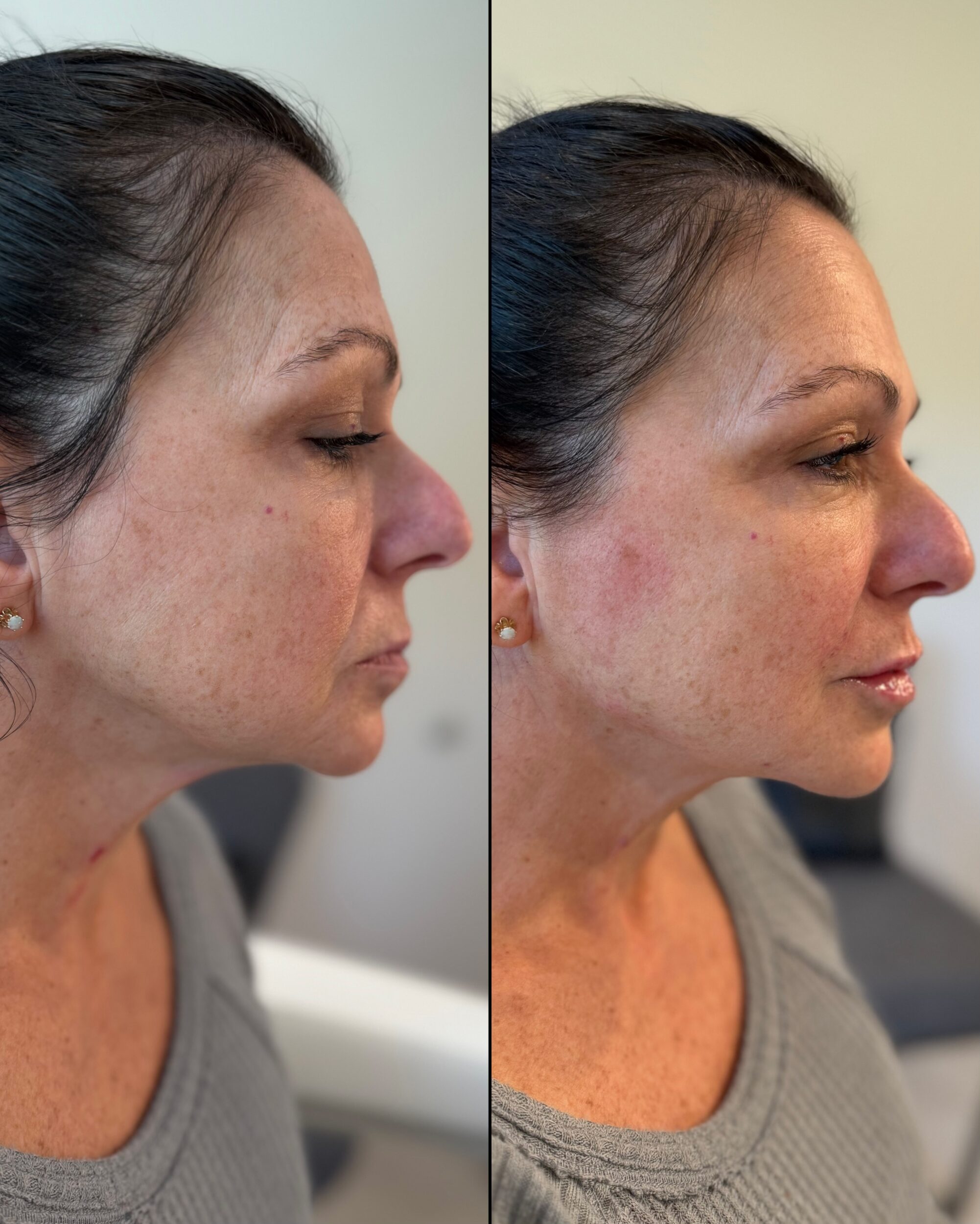 Before and After Image: Facial Balancing with Dermal Fillers - right-side