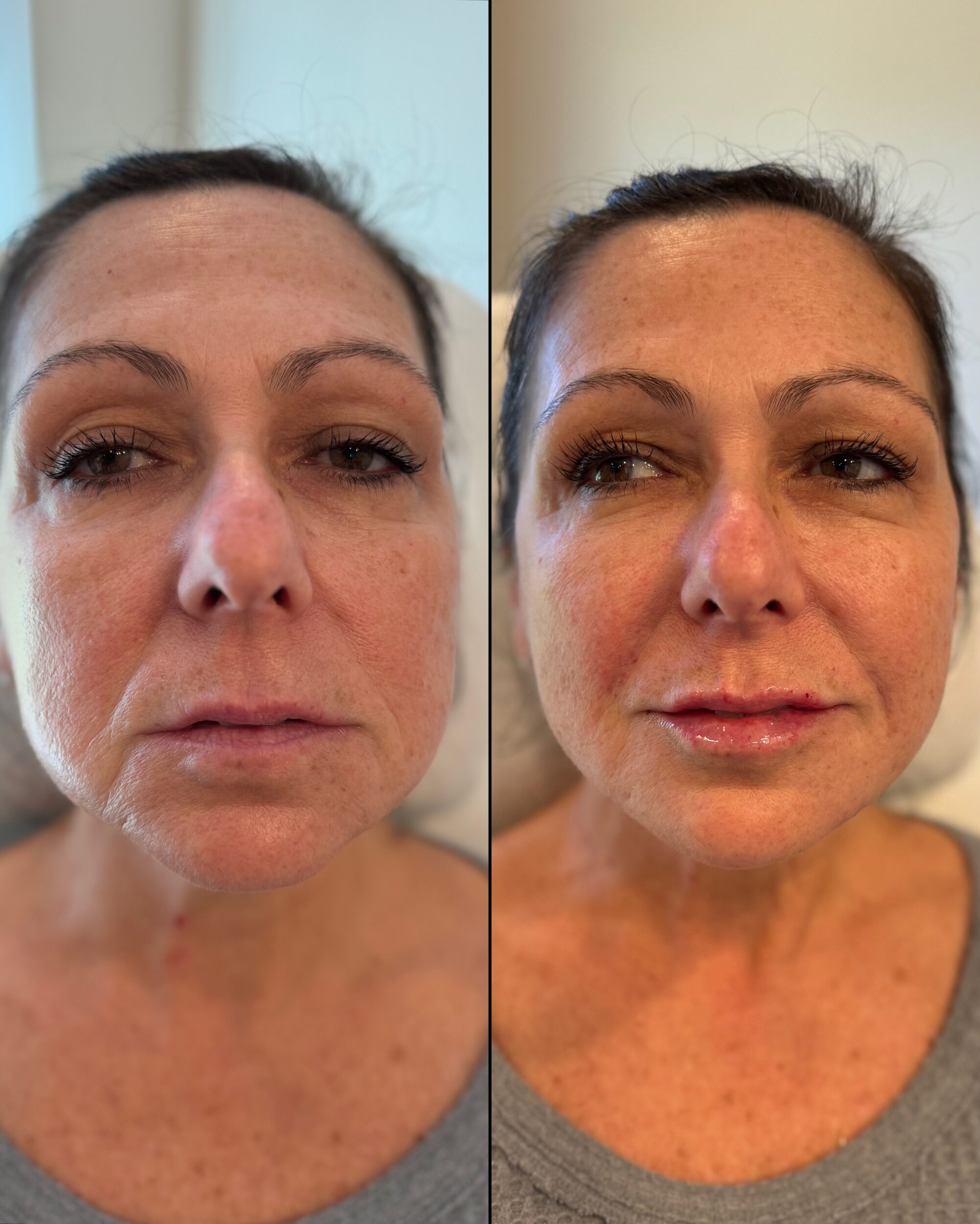 Before and After Image: Facial Balancing with Dermal Fillers - front