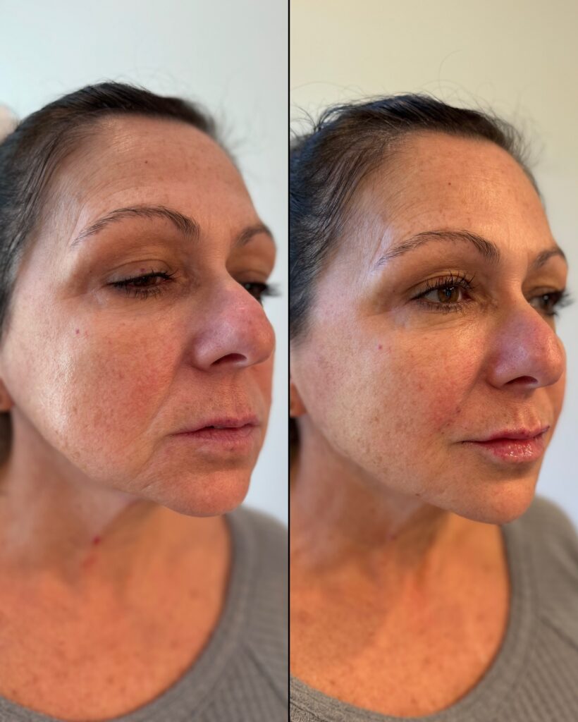 Before and After Image: Facial Balancing with Dermal Fillers - right-front-oblique