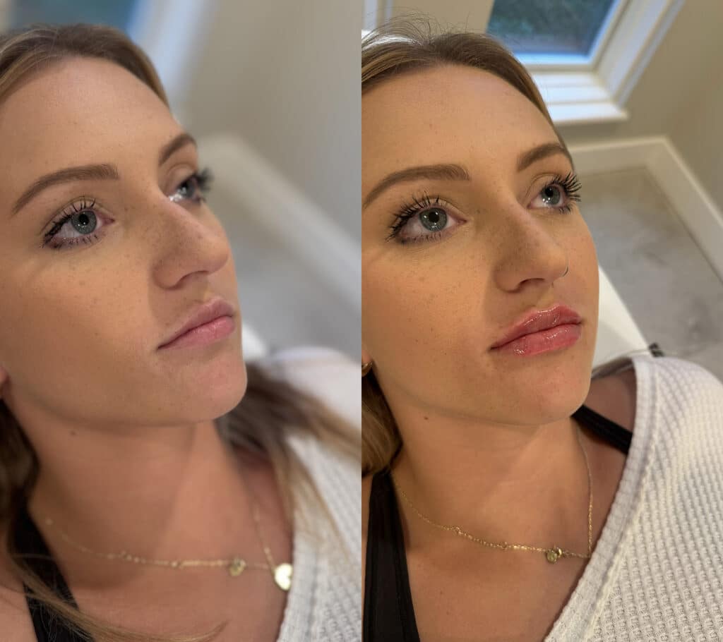 Before and After Image: Lip Filler - right-front-oblique