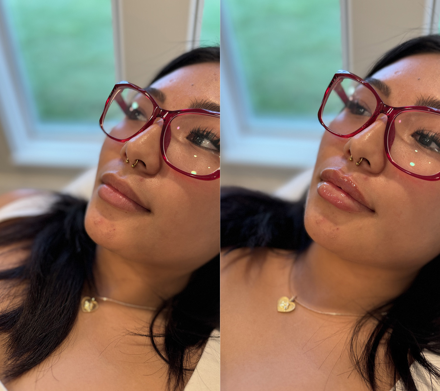 Before and After Image: Lip Filler - left-front-oblique