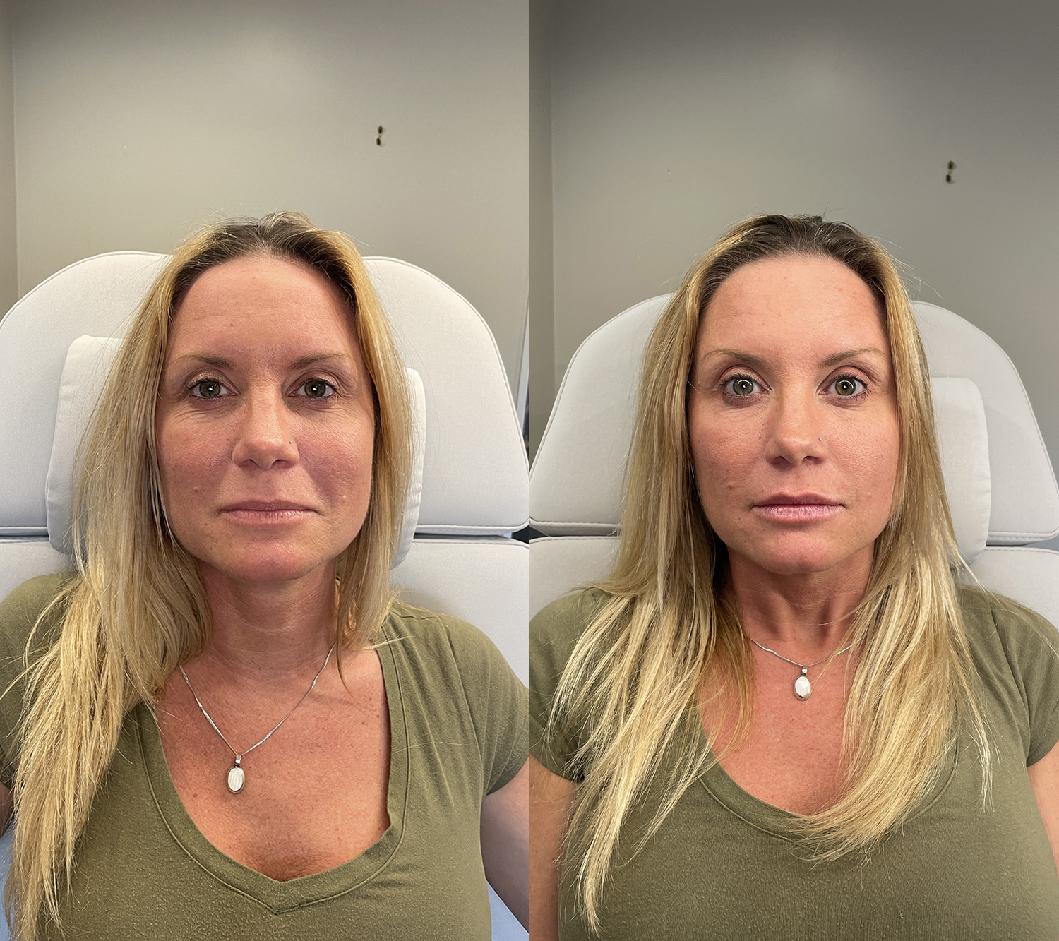 Before and After Image: Lip Filler - front