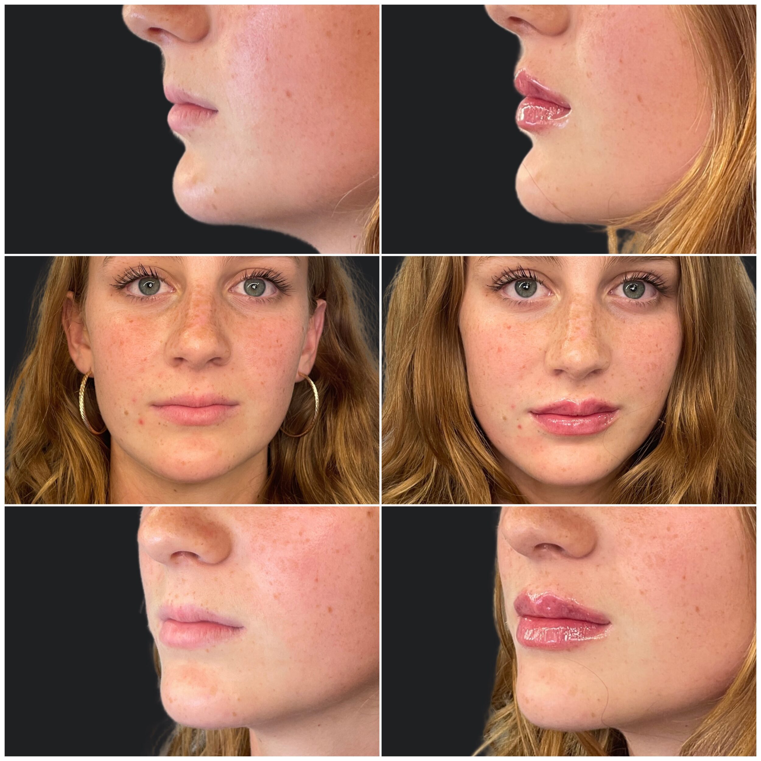 Before and After Image: Lip Filler - other