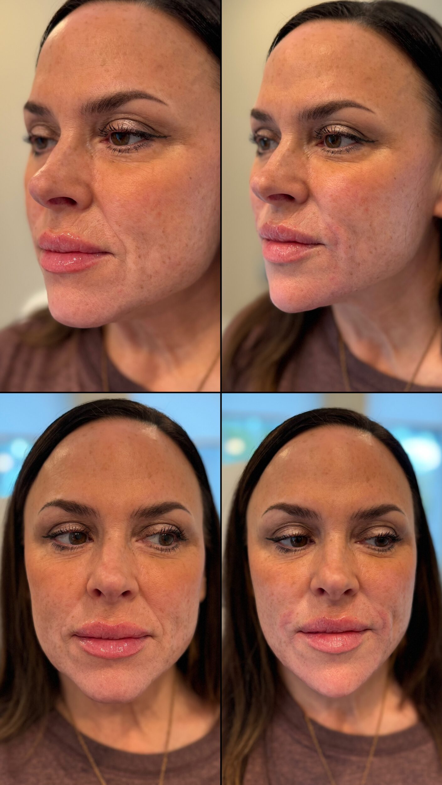 Before and After Image: Lips, Chin filler - other