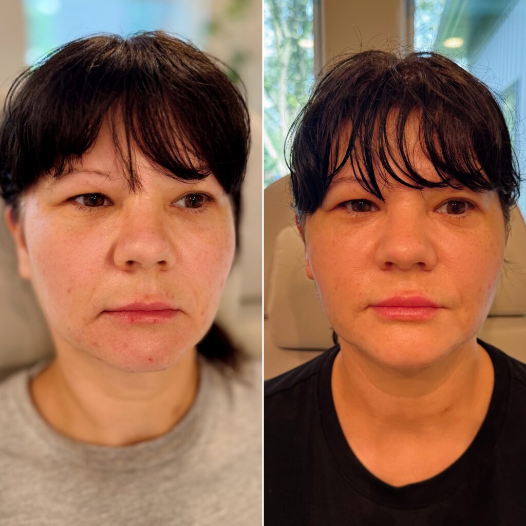Before and After Image: Lower Face Botox - front