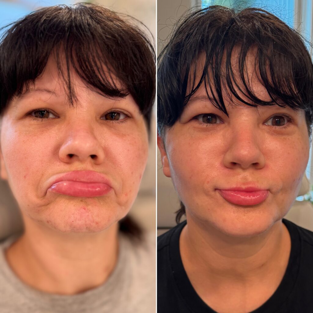 Before and After Image: Lower Face Botox - front