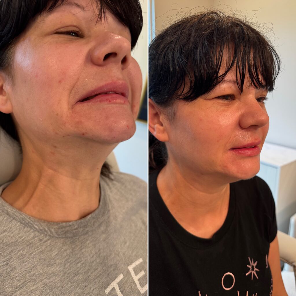 Before and After Image: Lower Face Botox - right-front-oblique