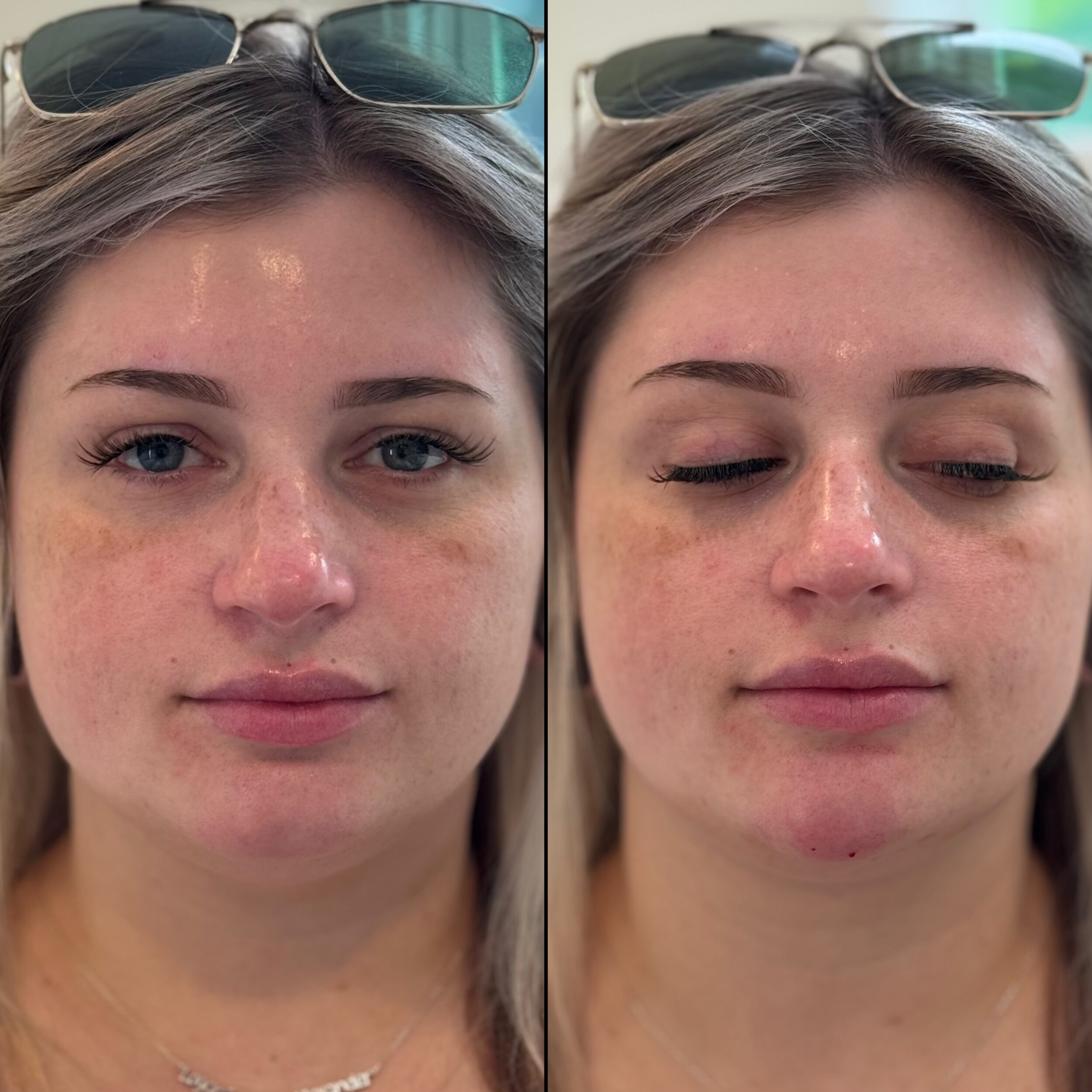 Before and After Image: Lower Face Tox, Lip Enhancement, Chin Enhancement - front