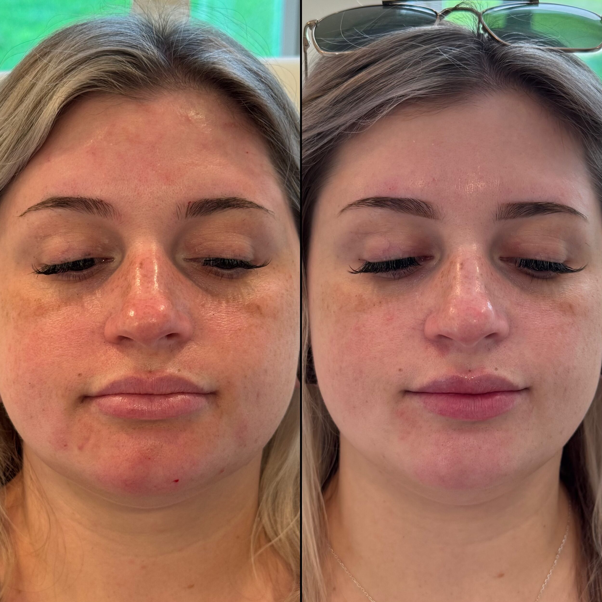 Before and After Image: Lower Face Tox, Lip Enhancement, Chin Enhancement - front