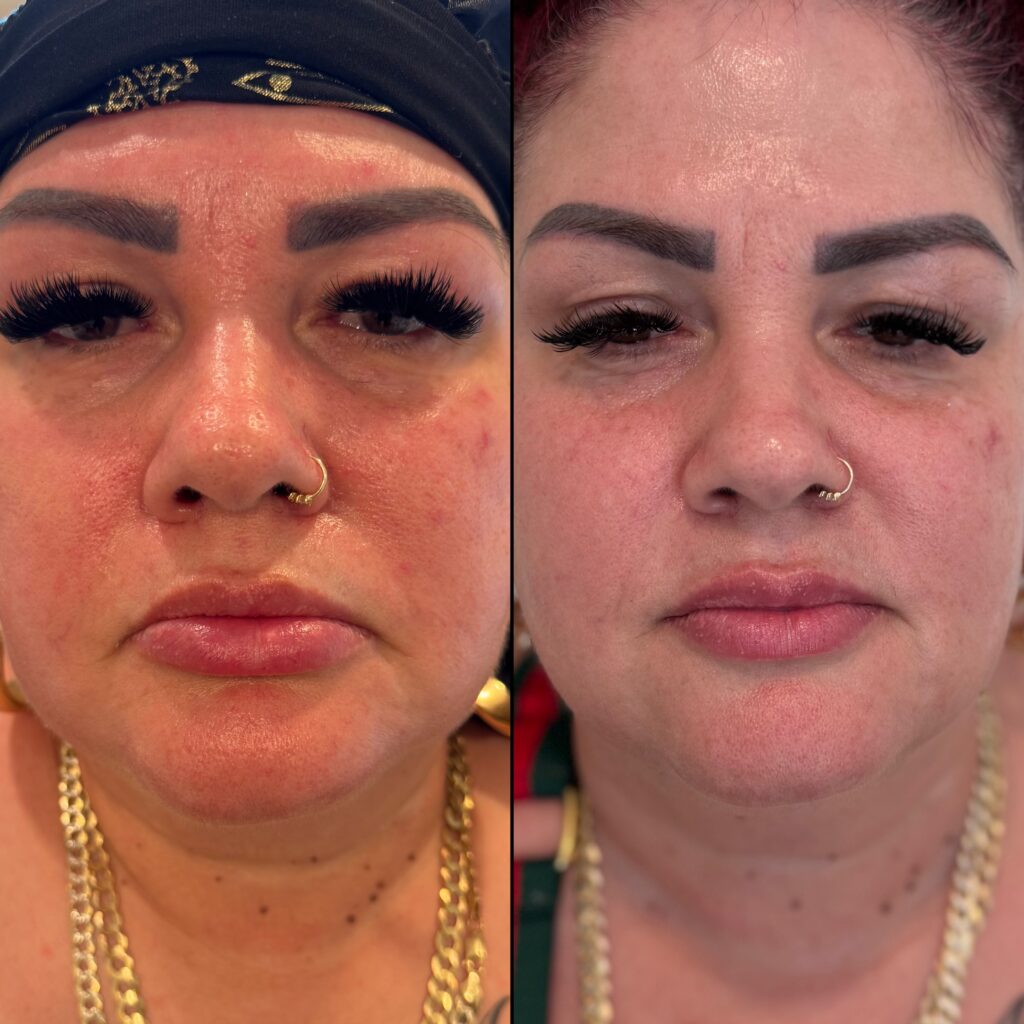 Before and After Image: Lower Face Tox - front