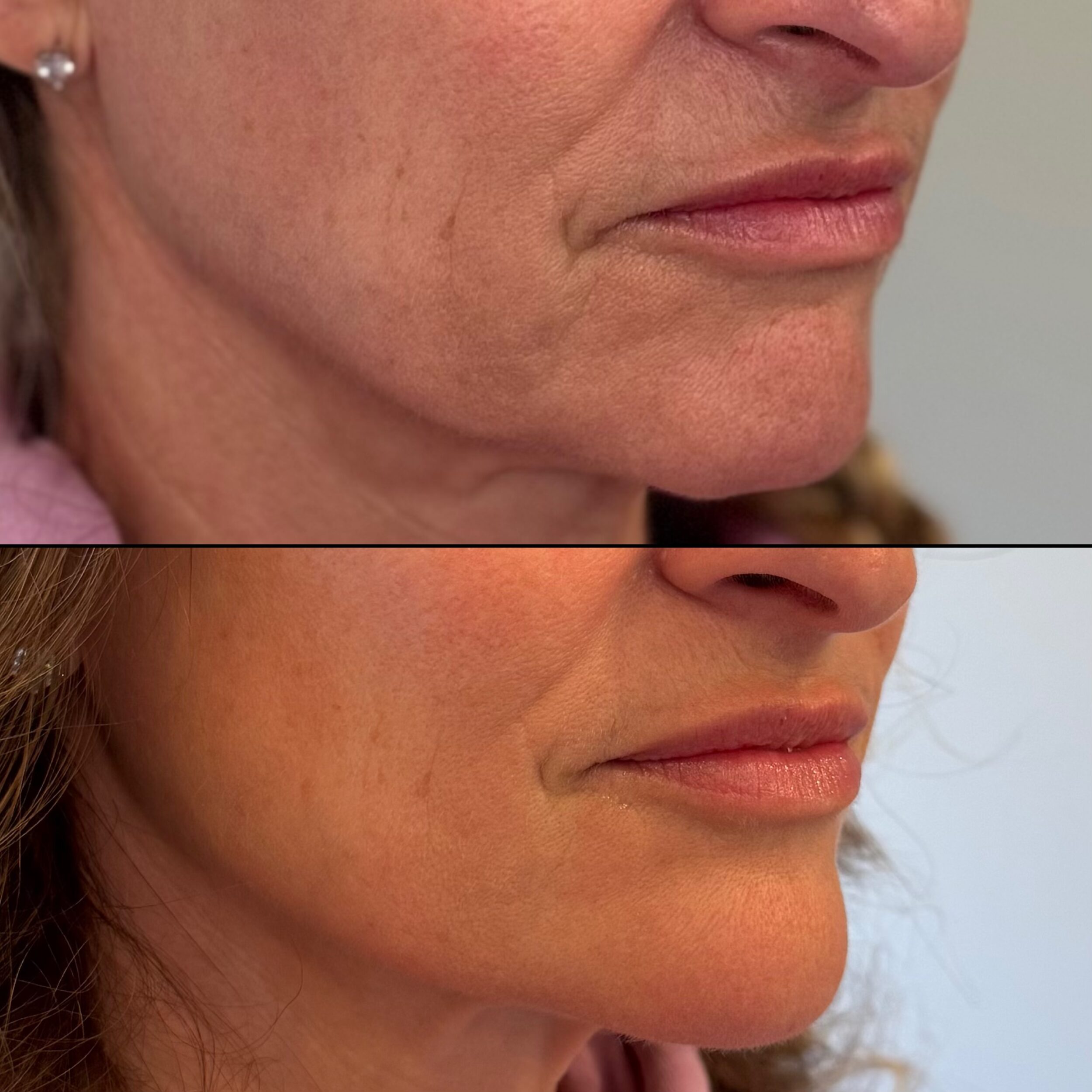 Before and After Image: Lower Face Tox - right-front-oblique