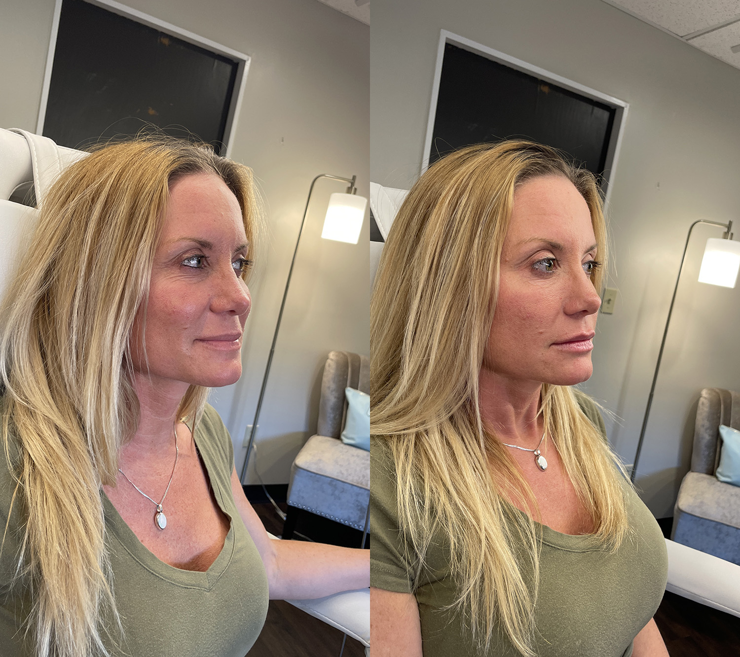 Before and After Image: Lip Filler - right-front-oblique