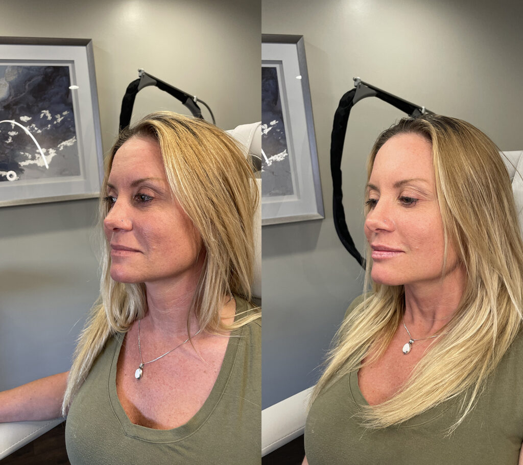 Before and After Image: Lip Filler - left-front-oblique