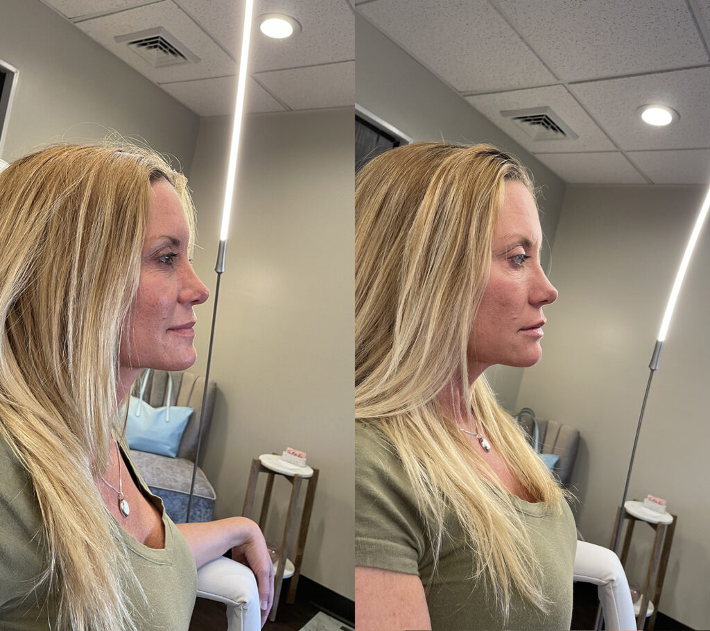 Before and After Image: Lip Filler - right-side